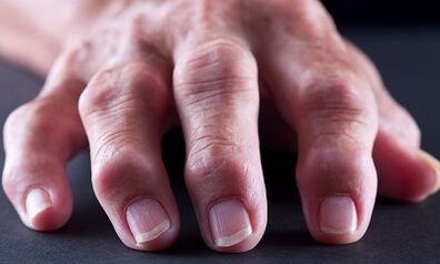 Menene banbanci tsakanin amhritis daga Arthrosis