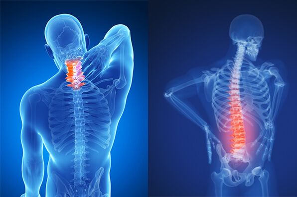 Osteochondrosis na cervical da lumbar kashin baya
