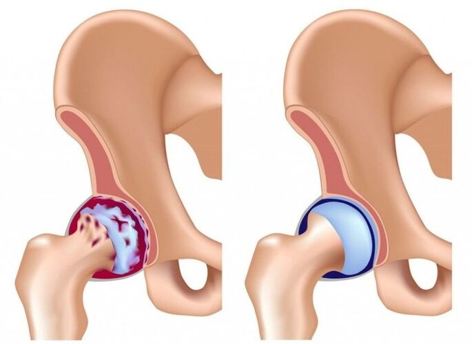 Lalacewa ga haɗin gwiwa na hip saboda arthrosis