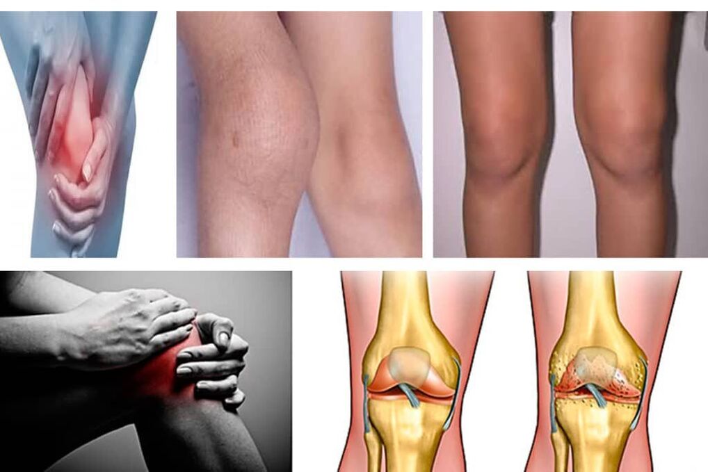 arthrosis abin da yake