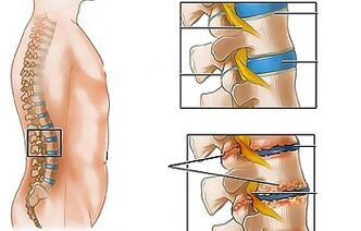 Sanadin osteochondrosis na lumbar