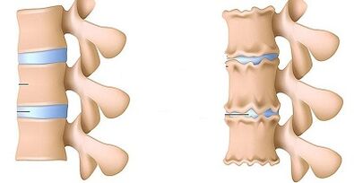 Yadda zaka gane kasancewar osteochondrosis na lumbar
